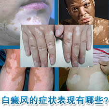 白癜风的症状表现有哪些